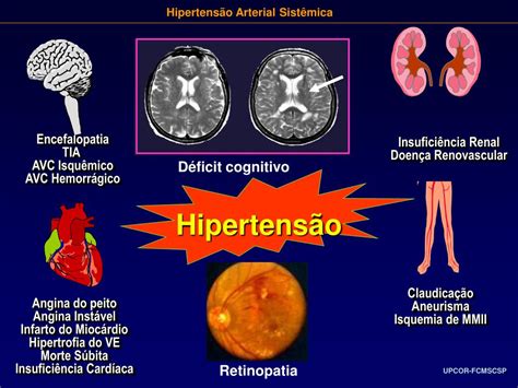 cid hipertensão arterial sistêmica